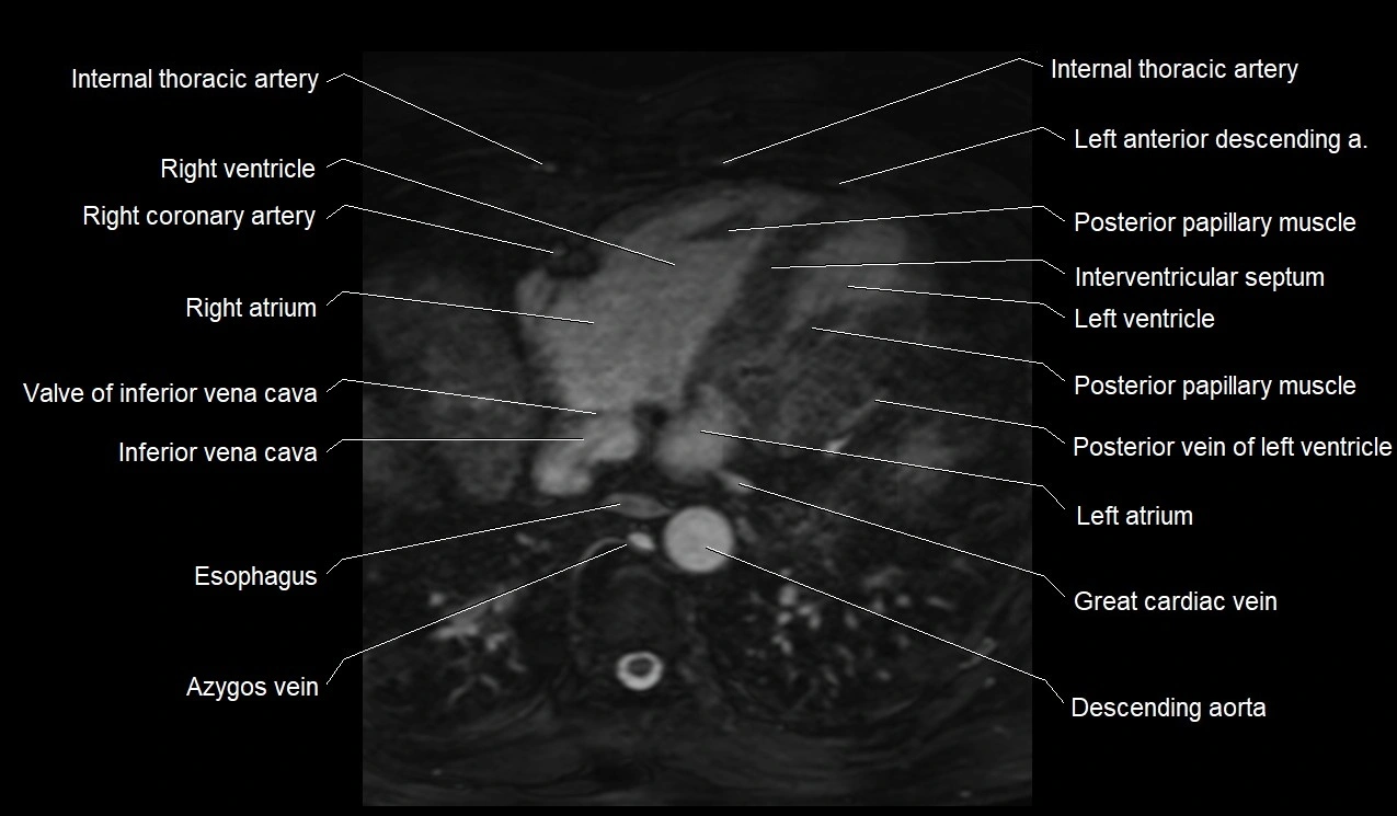 MRI heart coronary arteries and coronary veins anatomy axial image 34.webp